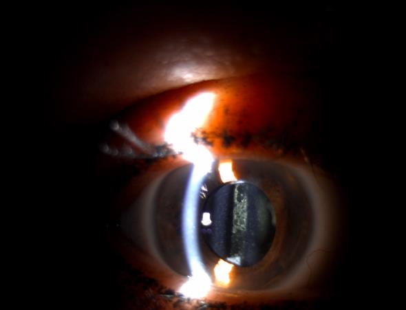 Παράδειγμα δευτερογενή καταρράκτη όπως φαίνεται στη σχισμοειδή λυχνία